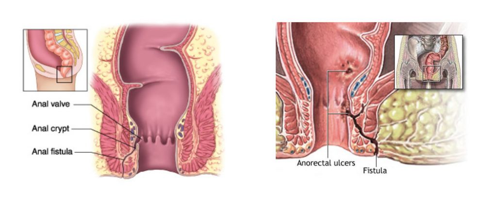 Appendisectomy_Laparoscopic_Jan_2019_001